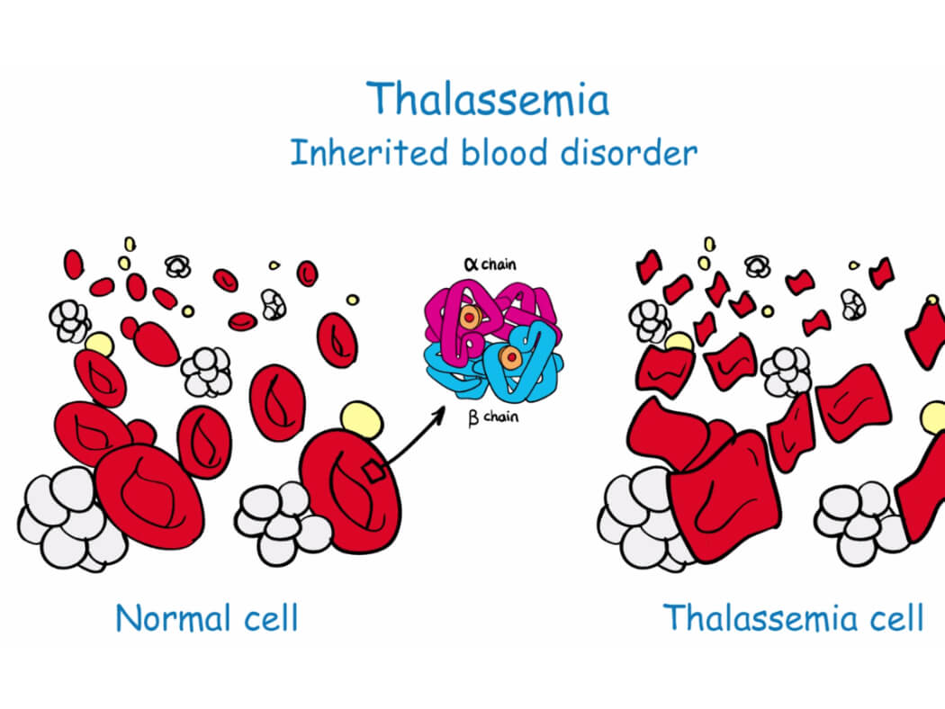 Nghiên cứu về bệnh Thalassemia